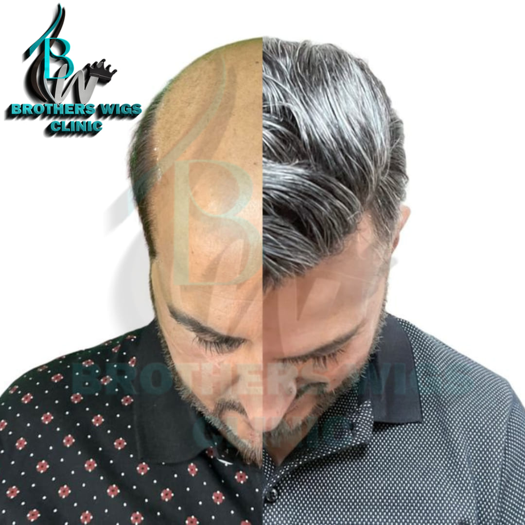 Human Hair Patch